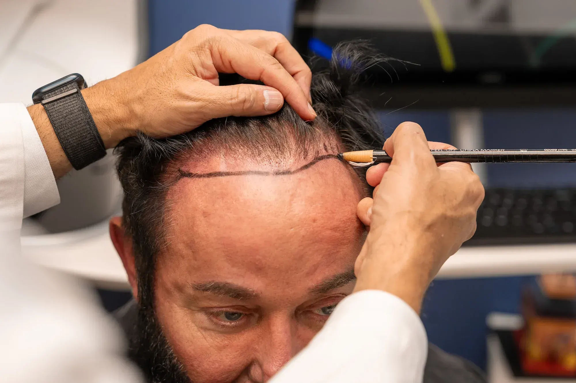 Patient examining frontal hairline during consultation at DSI Hair Algonquin
