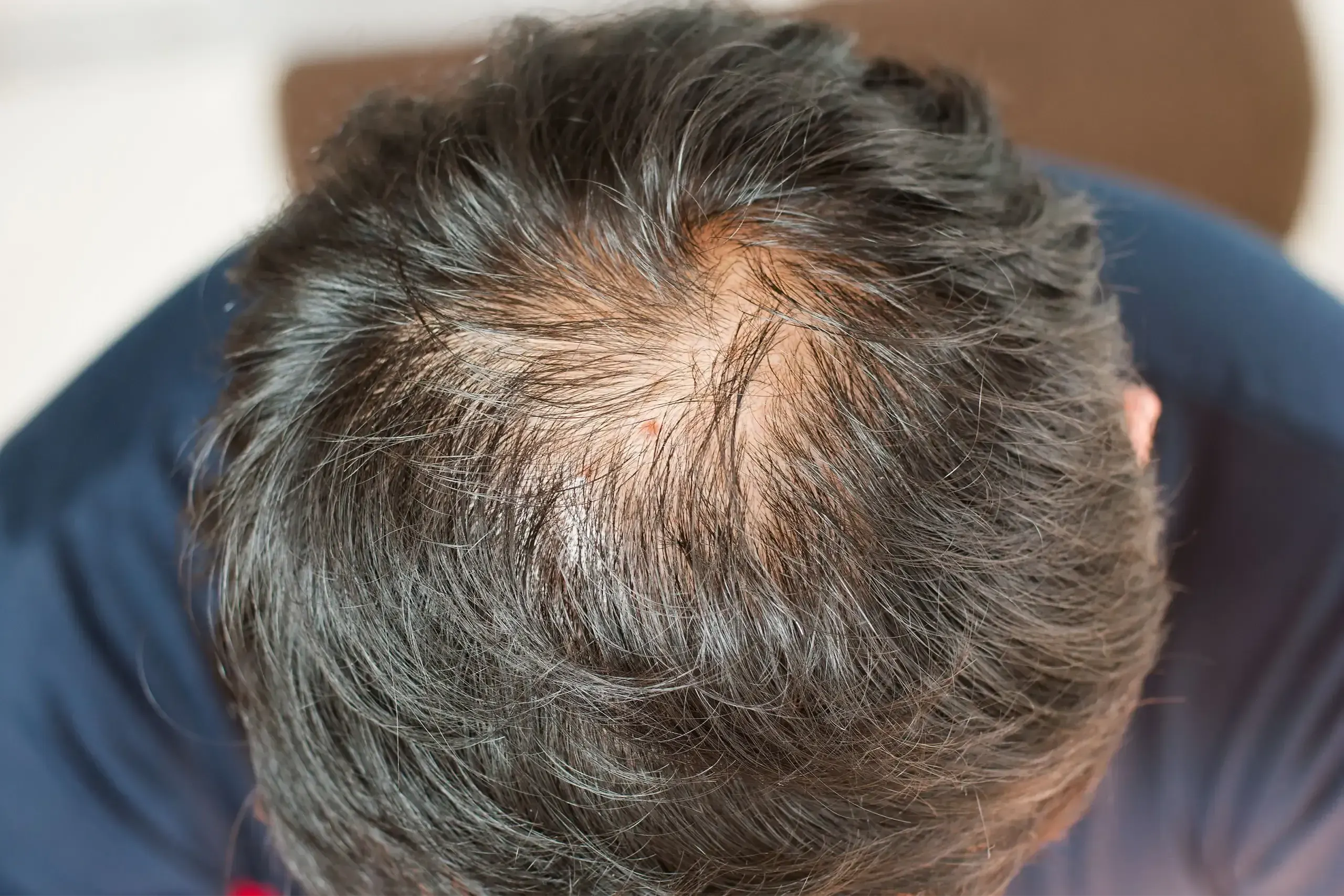 What Is <span>Alopecia</span>?