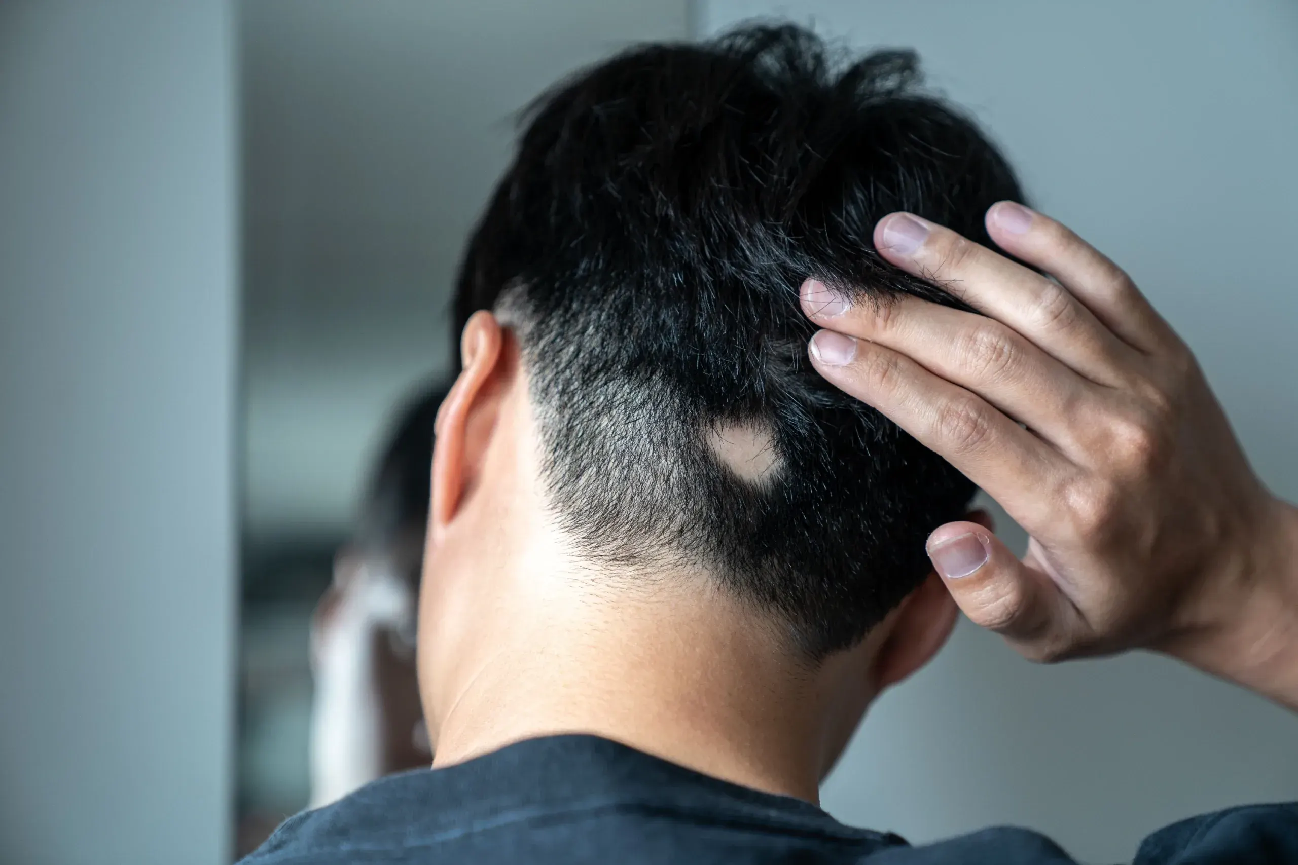 Alopecia