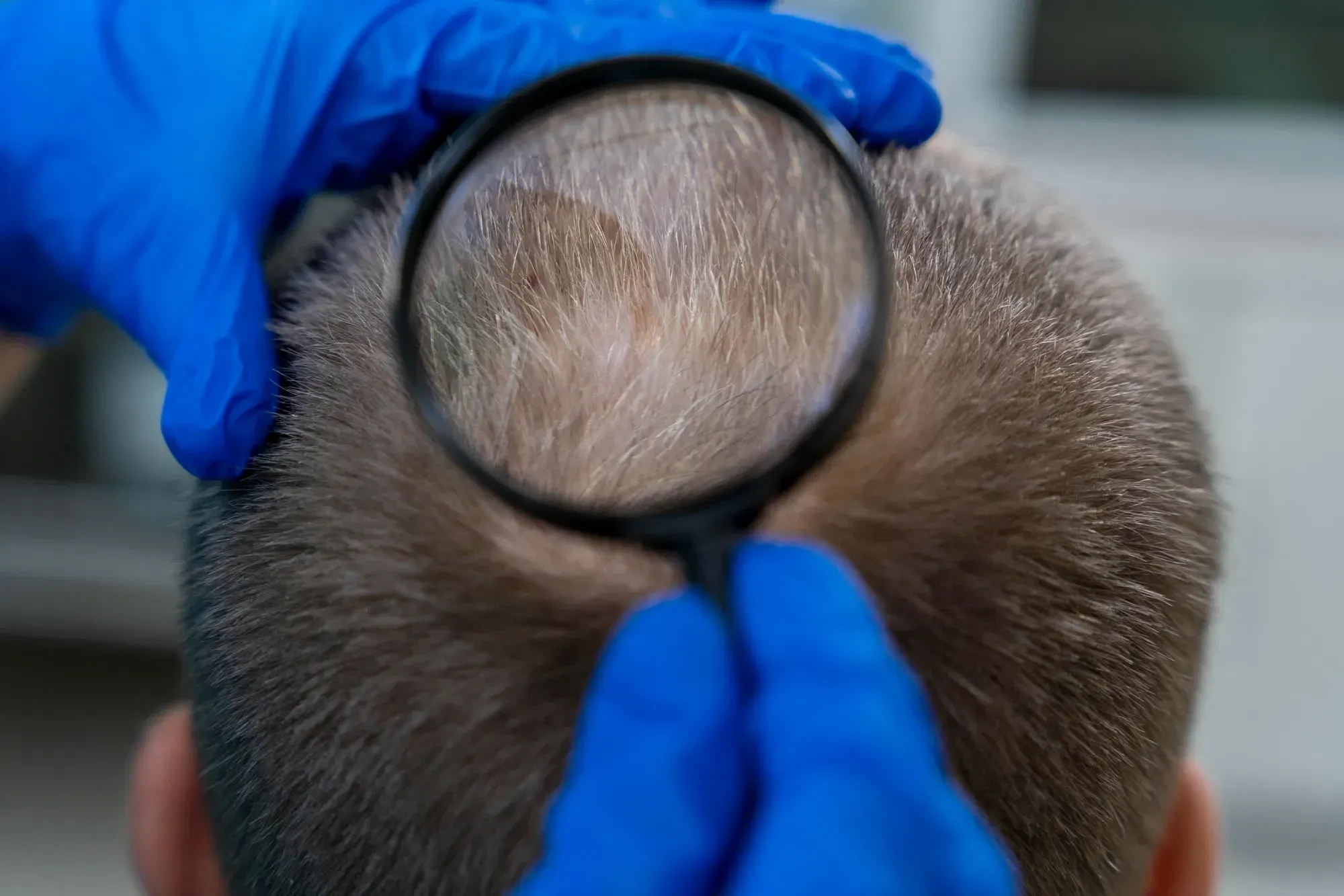 What Is <span>Diffuse Thinning</span>?