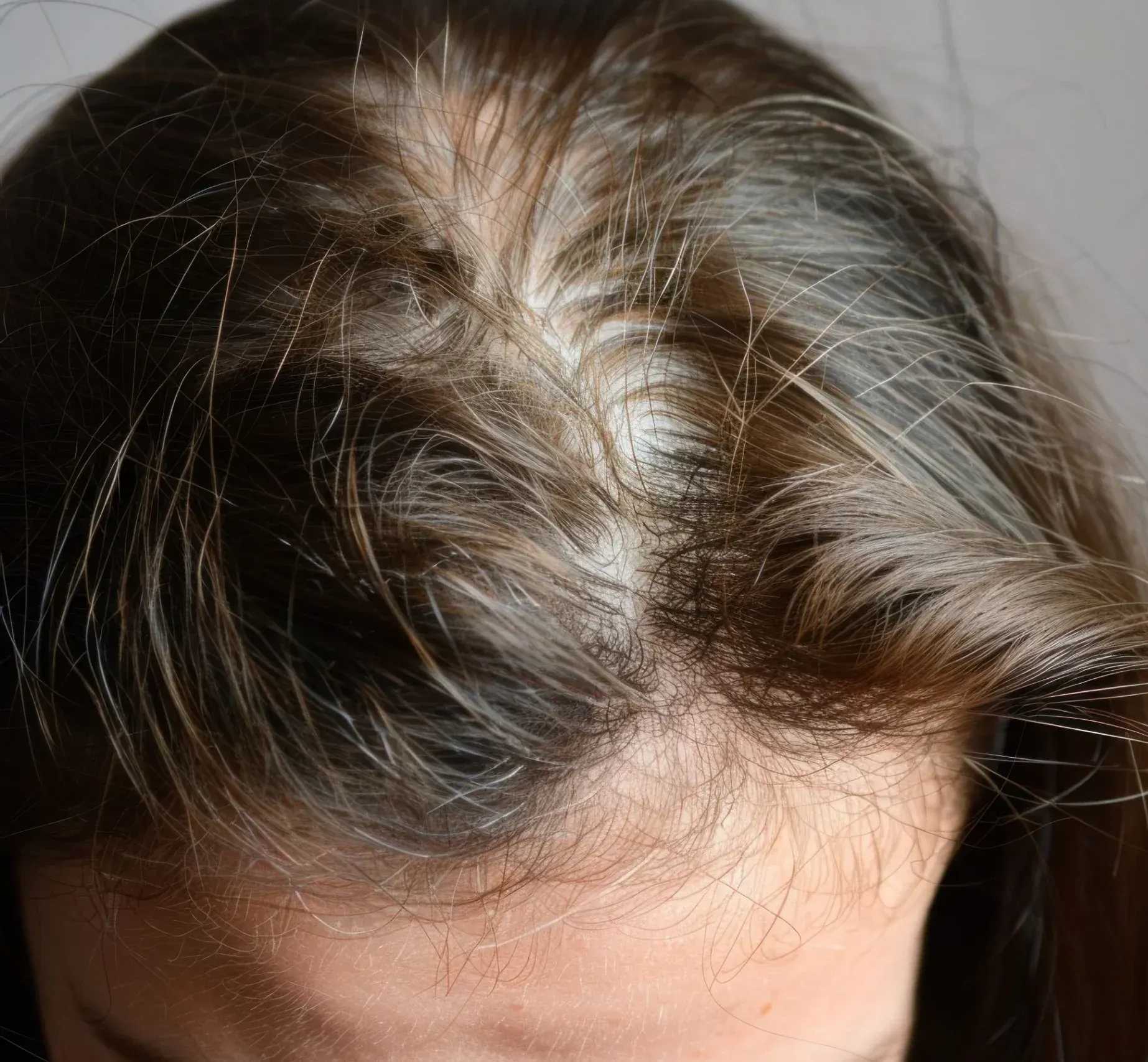 Why Choose DSI Hair for <span>Diffuse Thinning</span> Treatment
