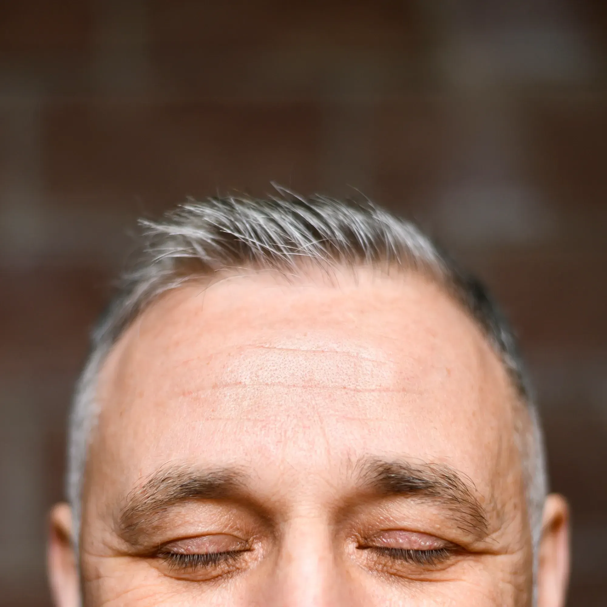 Close-up of frontal hairline showing early thinning at DSI Hair Algonquin