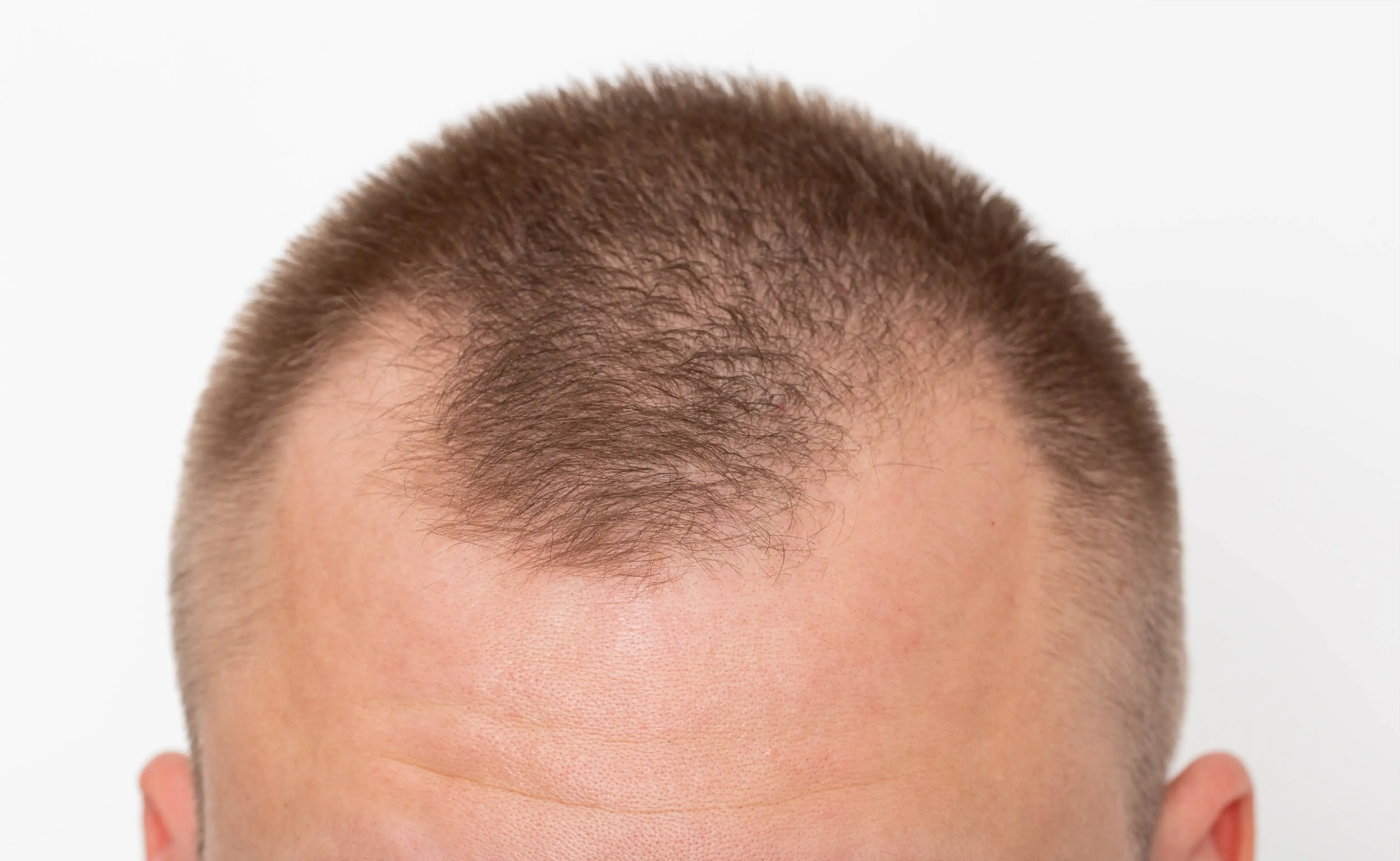 Person concerned about frontal hairline recession at DSI Hair Algonquin