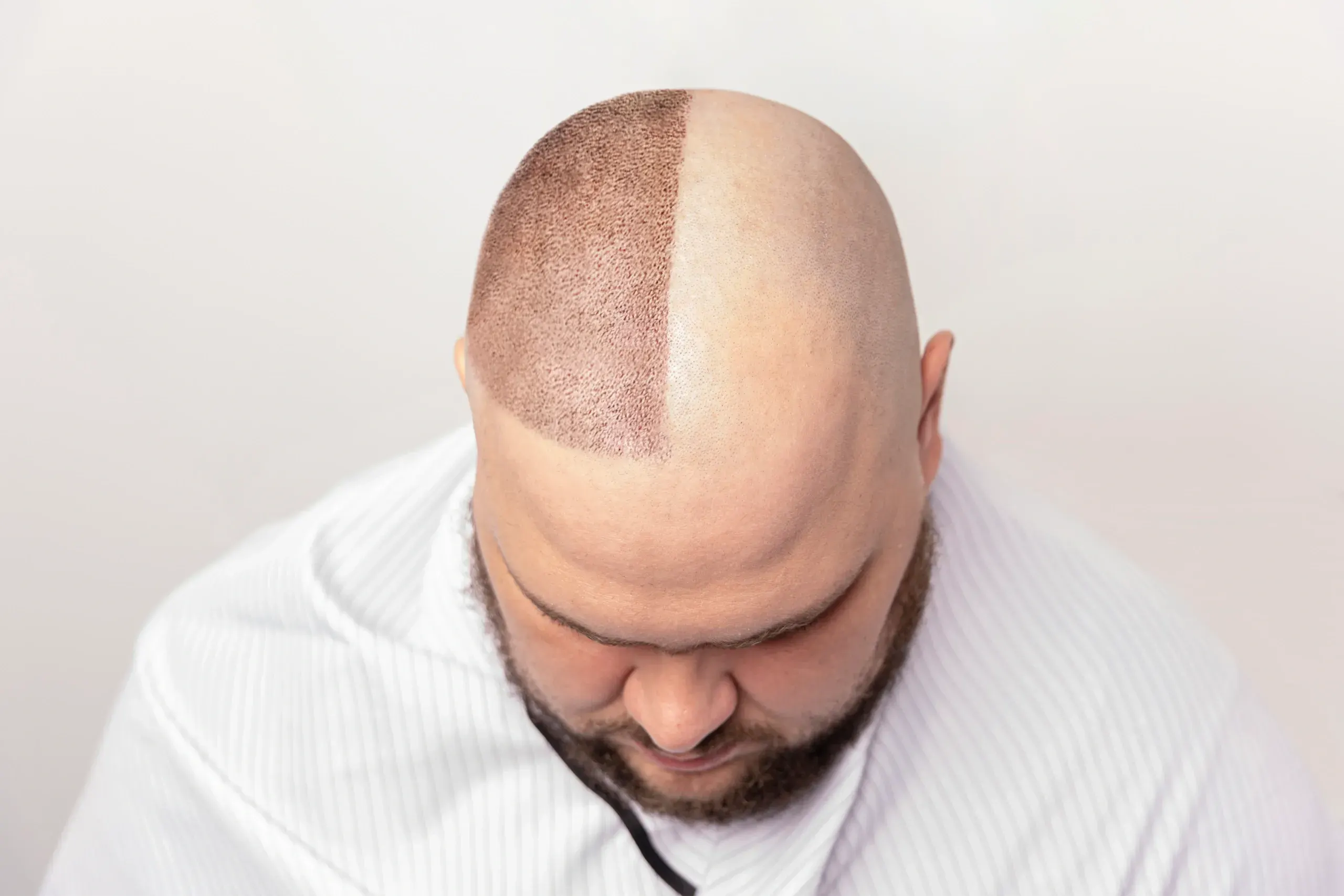 3 Month Hair Transplant Month by Month | Results Timeline