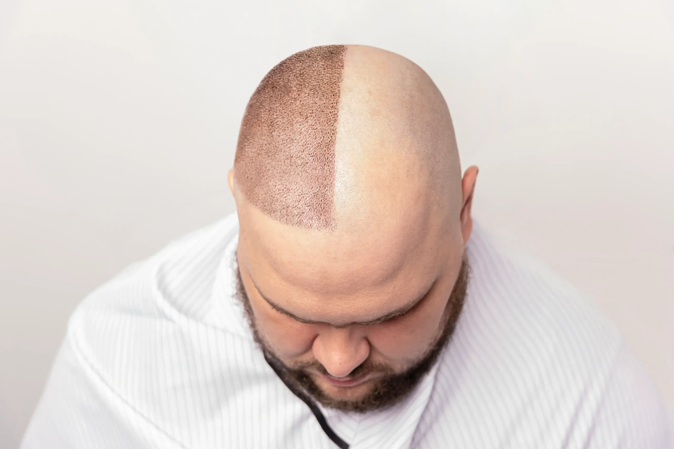 3 Month Hair Transplant Month by Month | Results Timeline