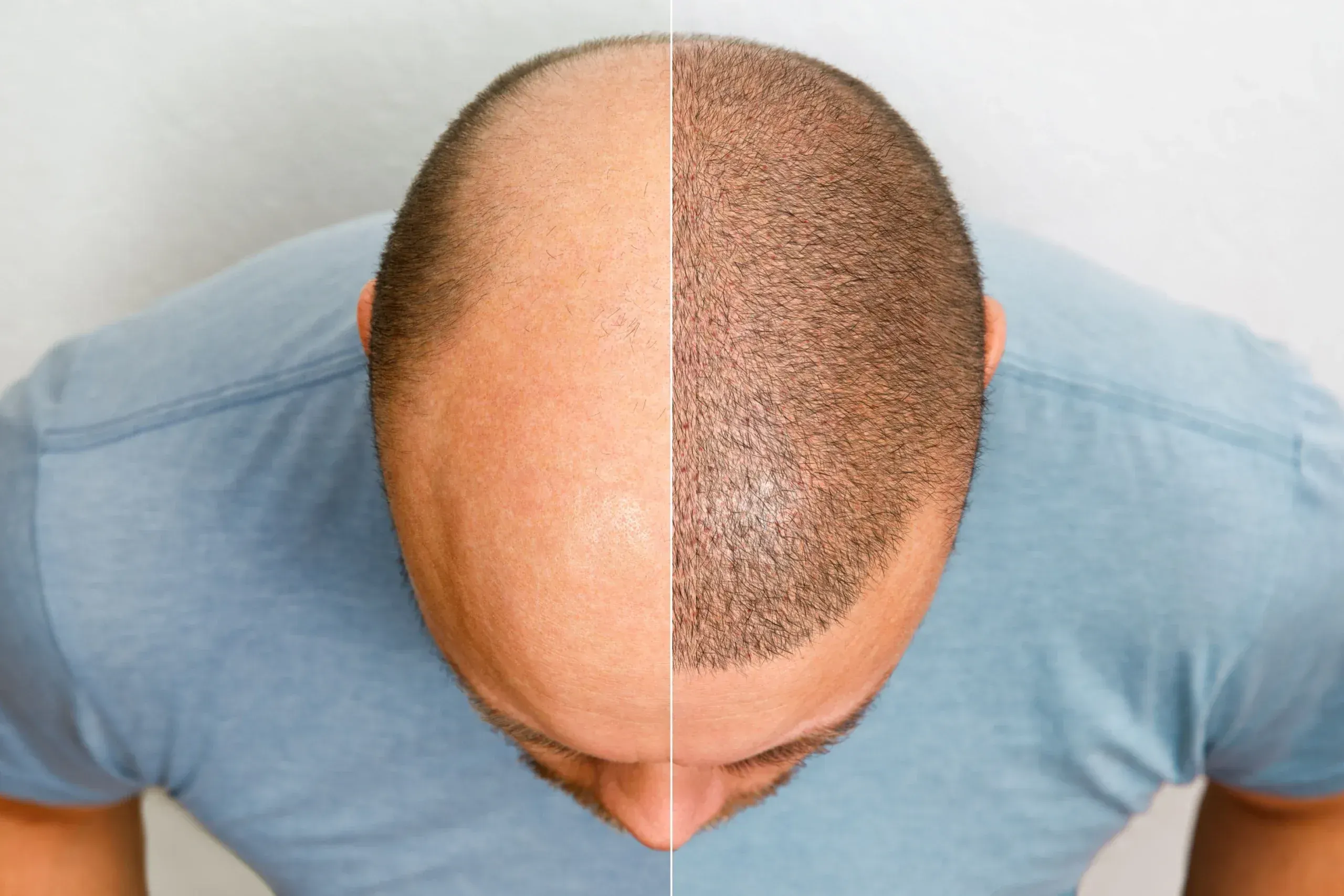 Signs You May Be Dealing with <span>Hair Transplant Scarring</span>