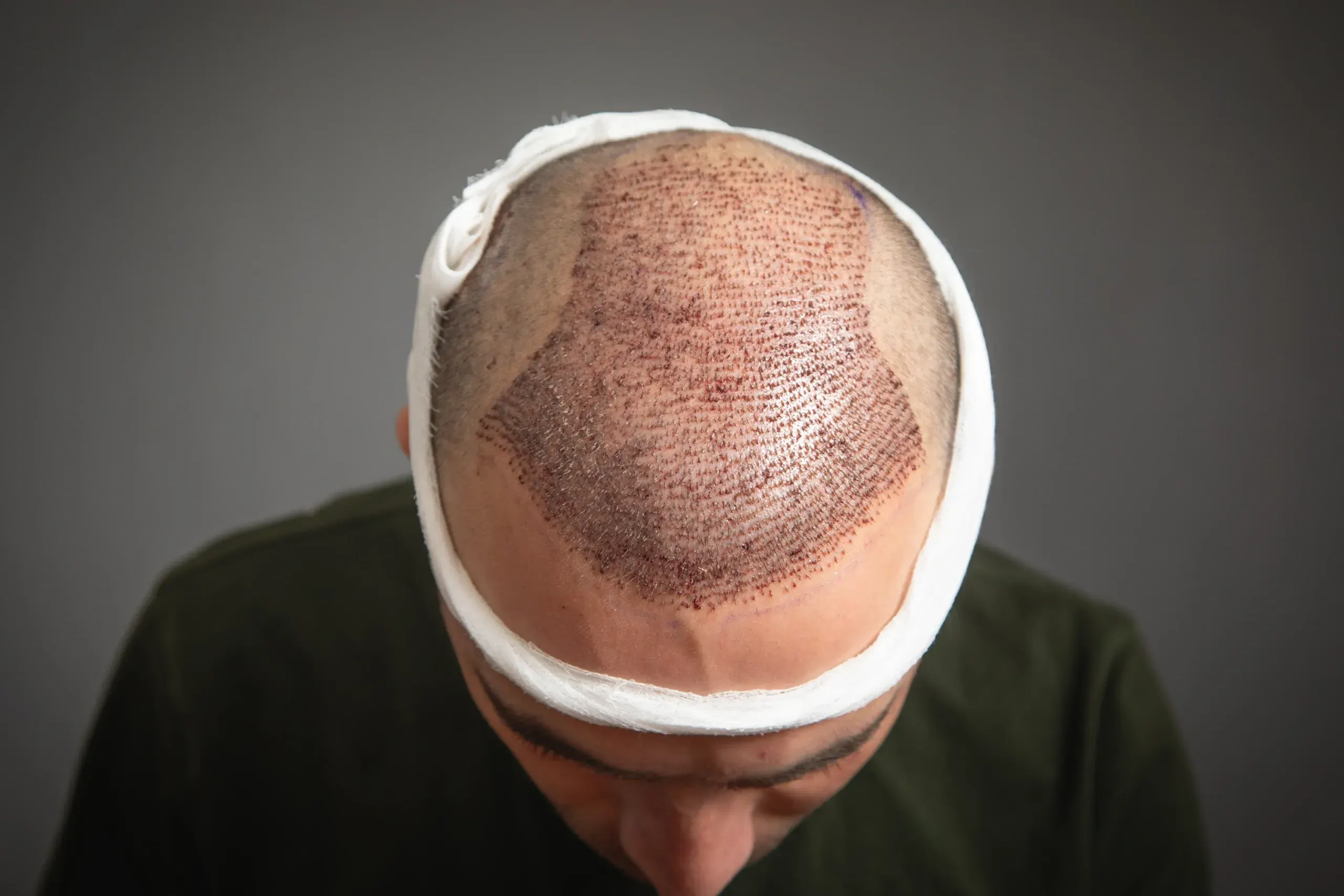 Hair Transplant Scar