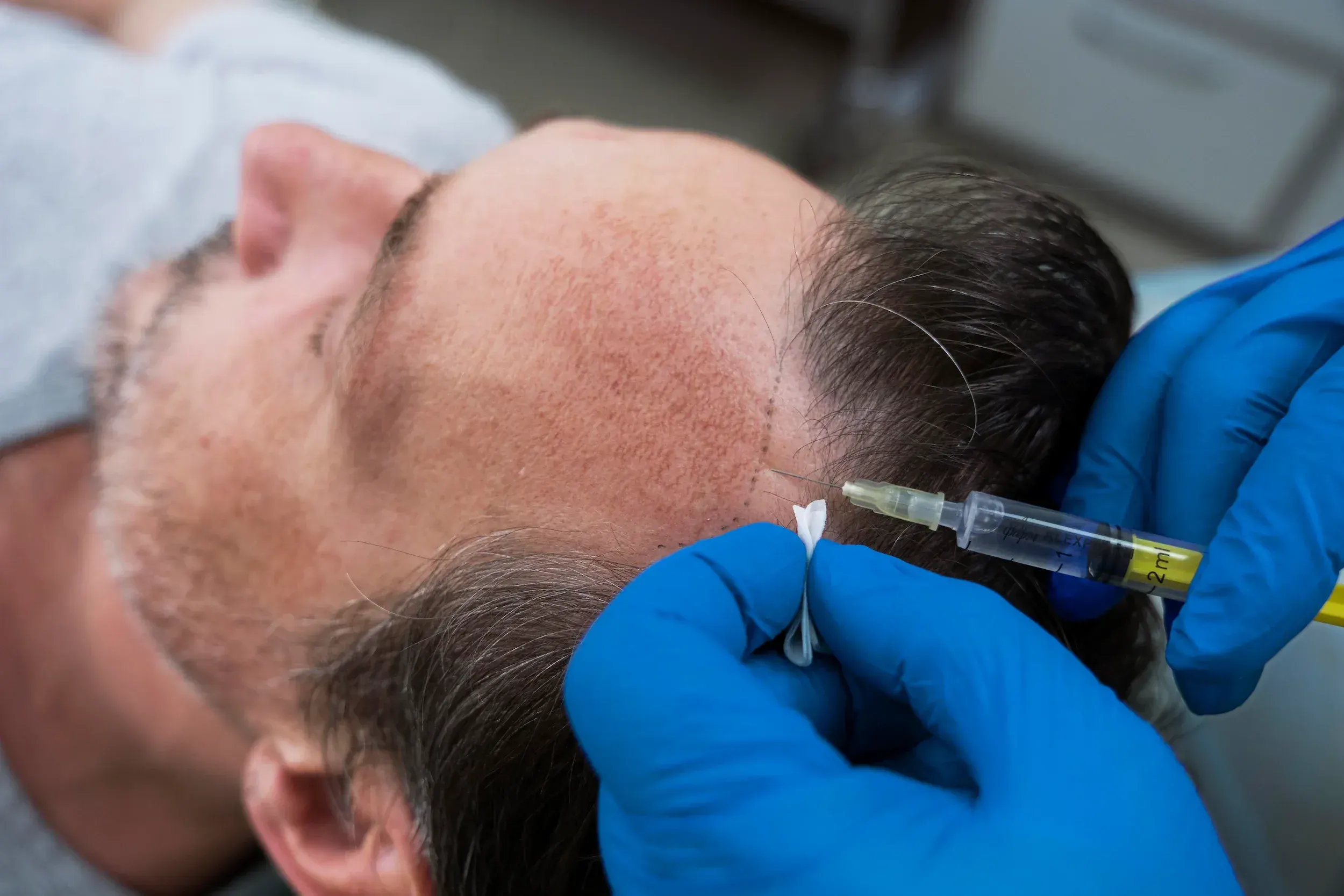 Dr. Vic Khanna MD board certified dermatologist at DSI Hair in Algonquin Illinois discussing finasteride side effects and hair loss treatment options with a male patient during a consultation