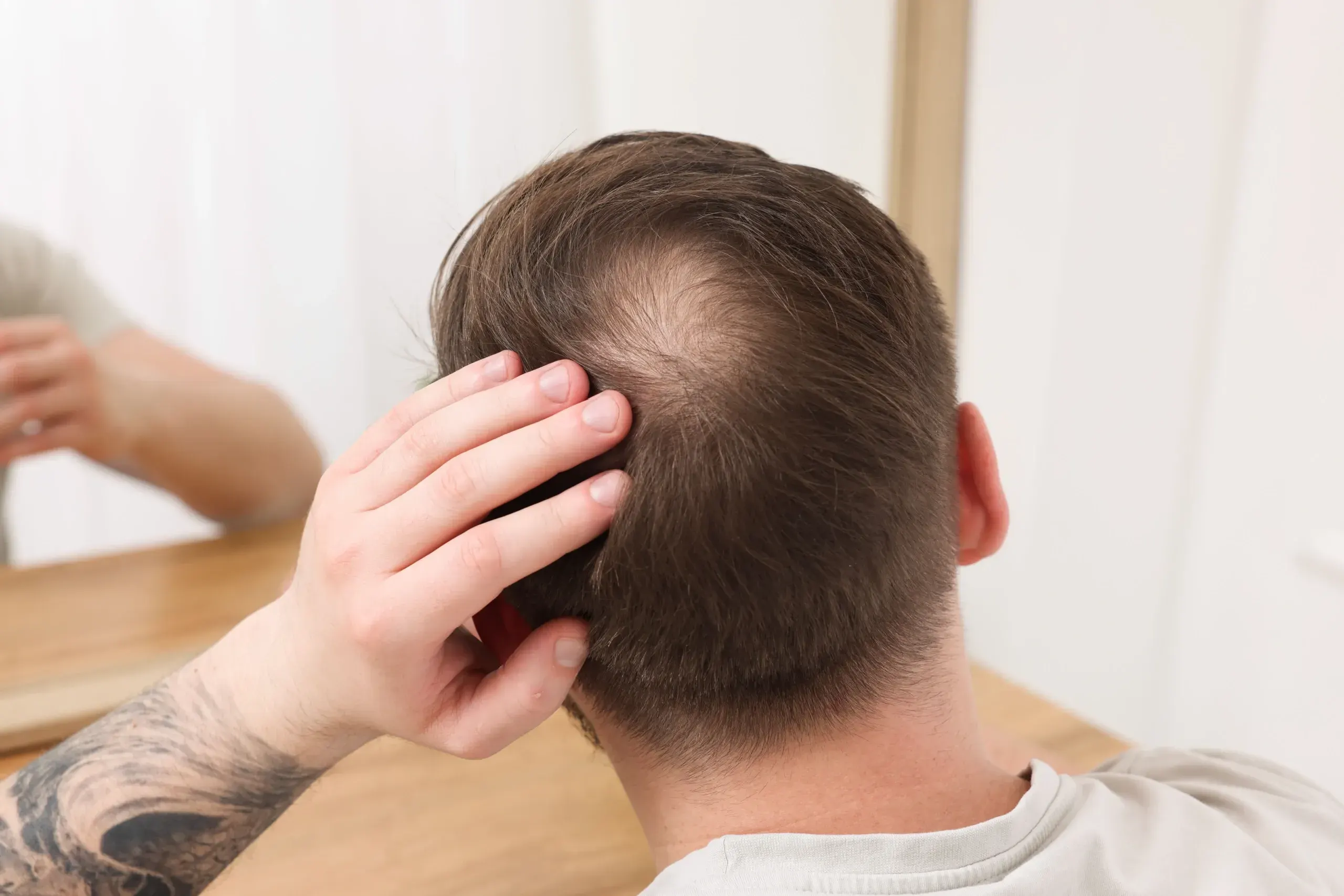 How Can You Prevent Balding?