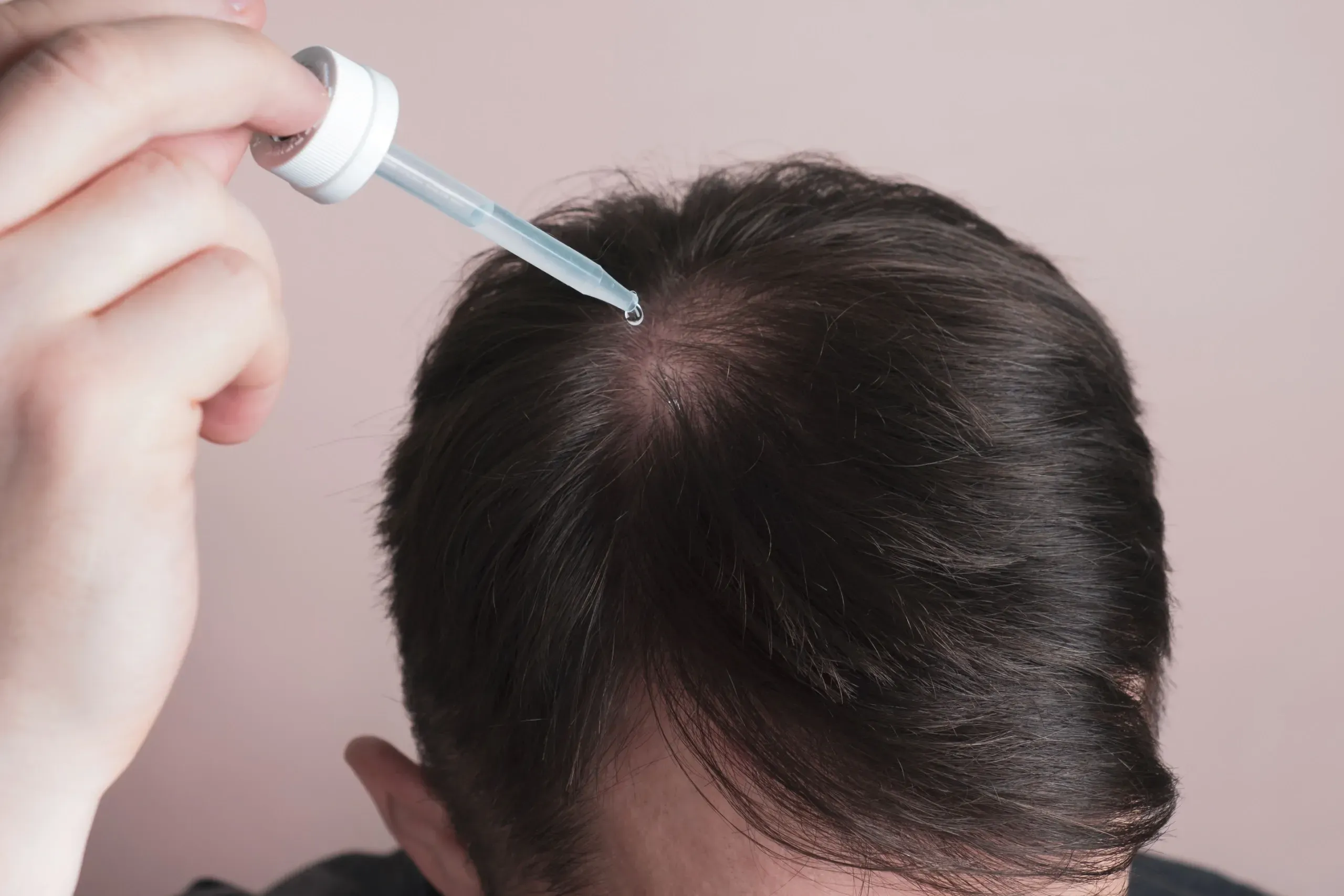 Is Oral Minoxidil Better Than Topical?