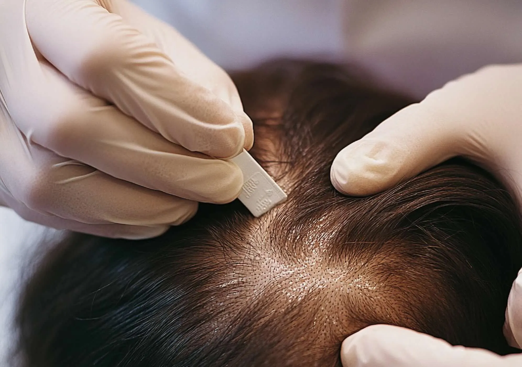 DSI Hair dermatologist in Algonquin Illinois examining a patient's scalp under a dermatoscope to evaluate seborrheic dermatitis and its relationship to hair loss and thinning