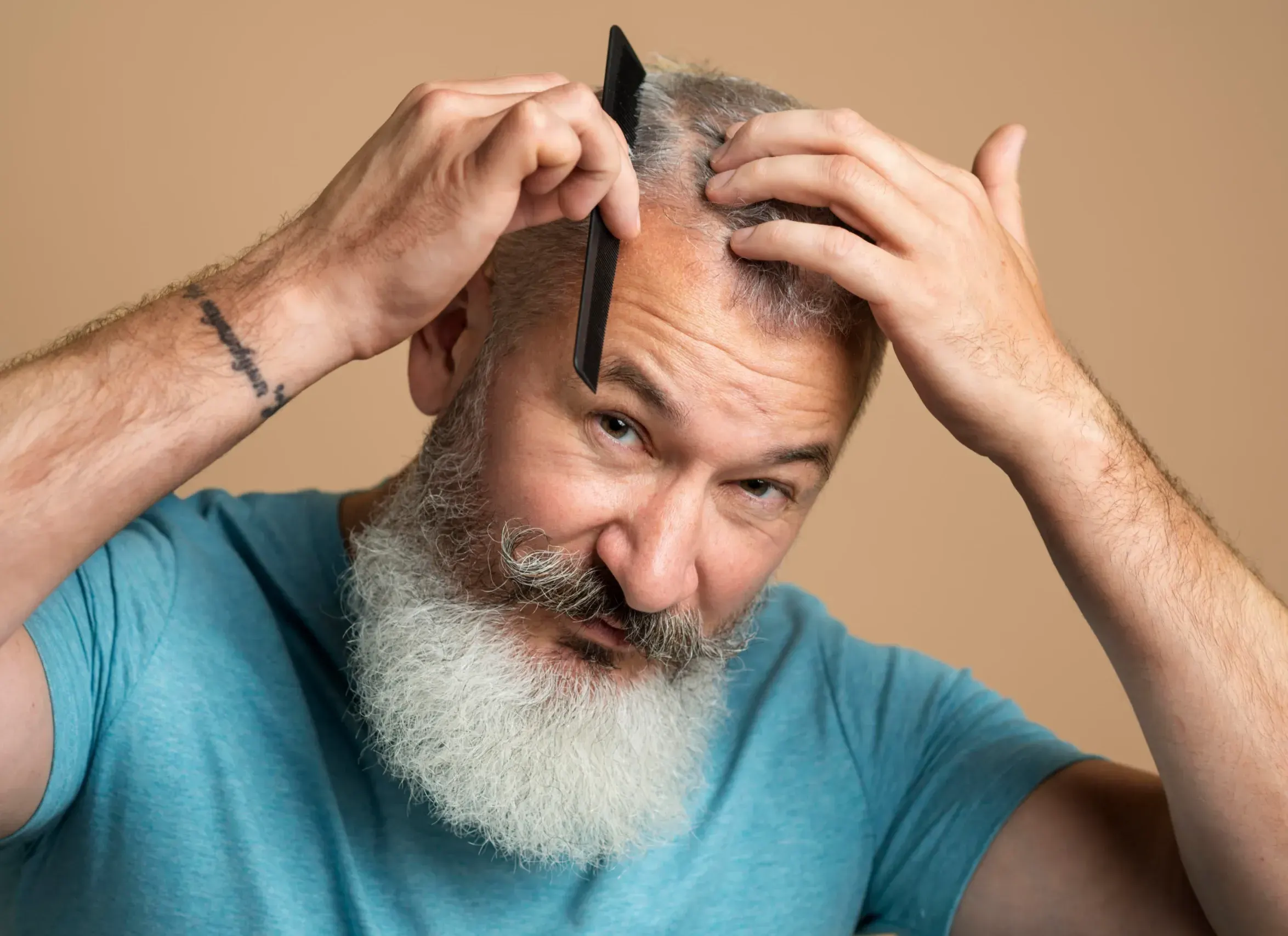 Why Choose DSI Hair for <span>Receding Hairline</span> Treatment