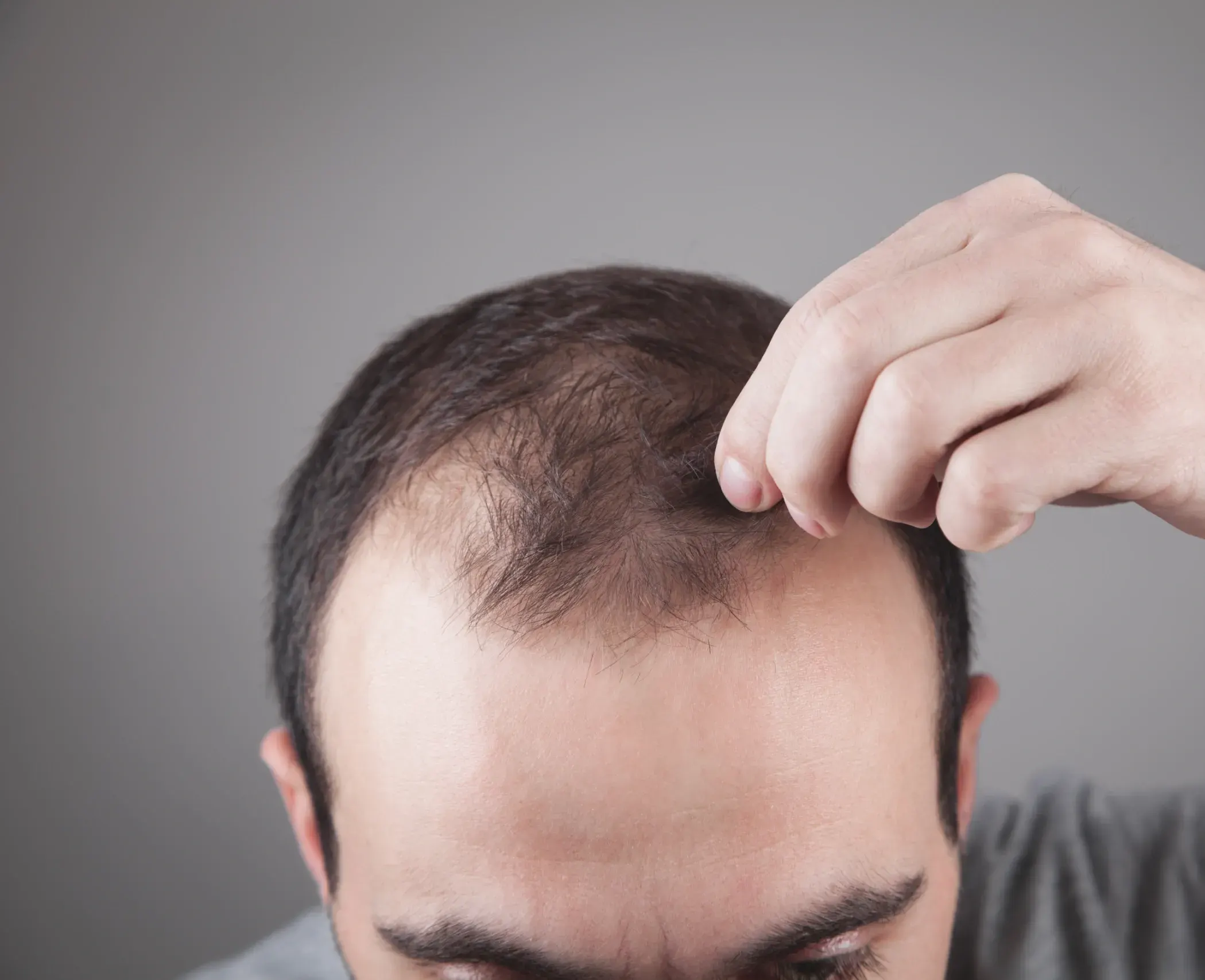 Signs You May Have a <span>Receding Hairline</span>
