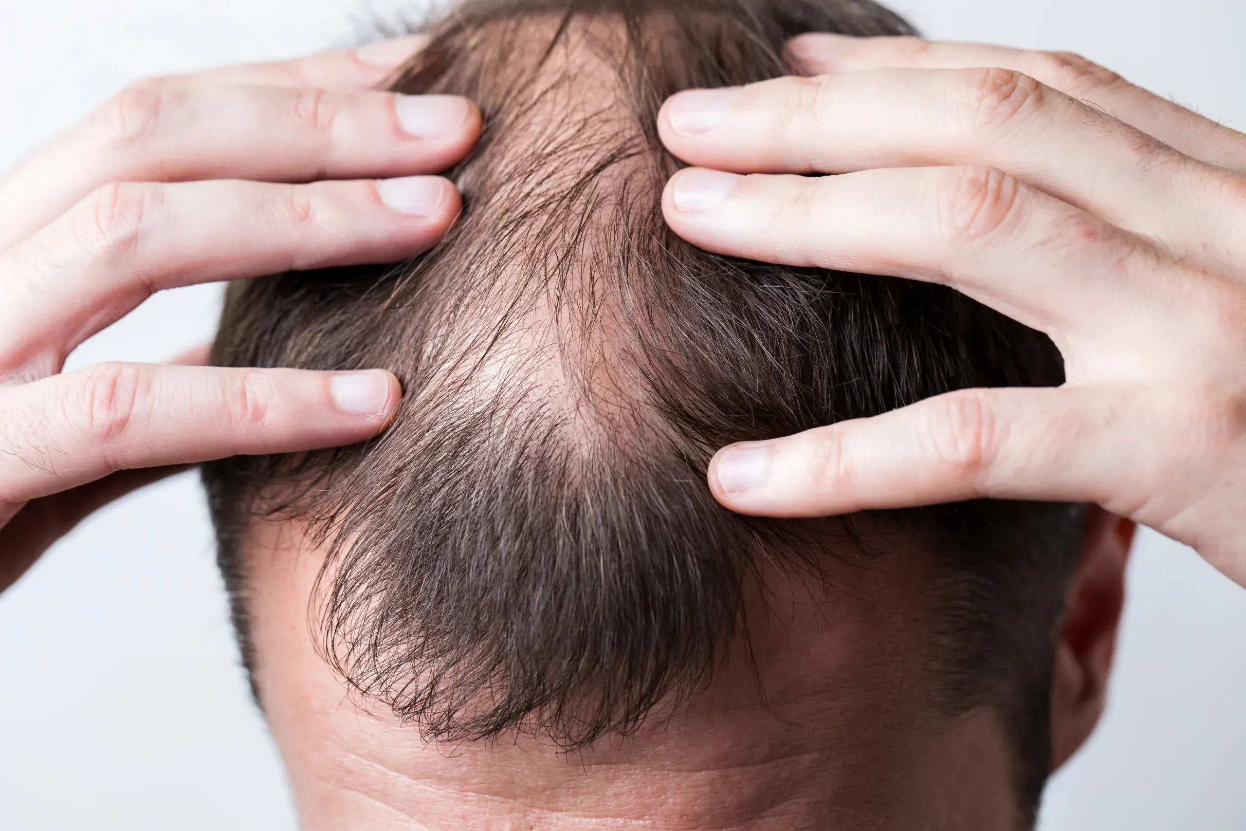 Signs You May Be Experiencing <span>Thinning Hair</span>