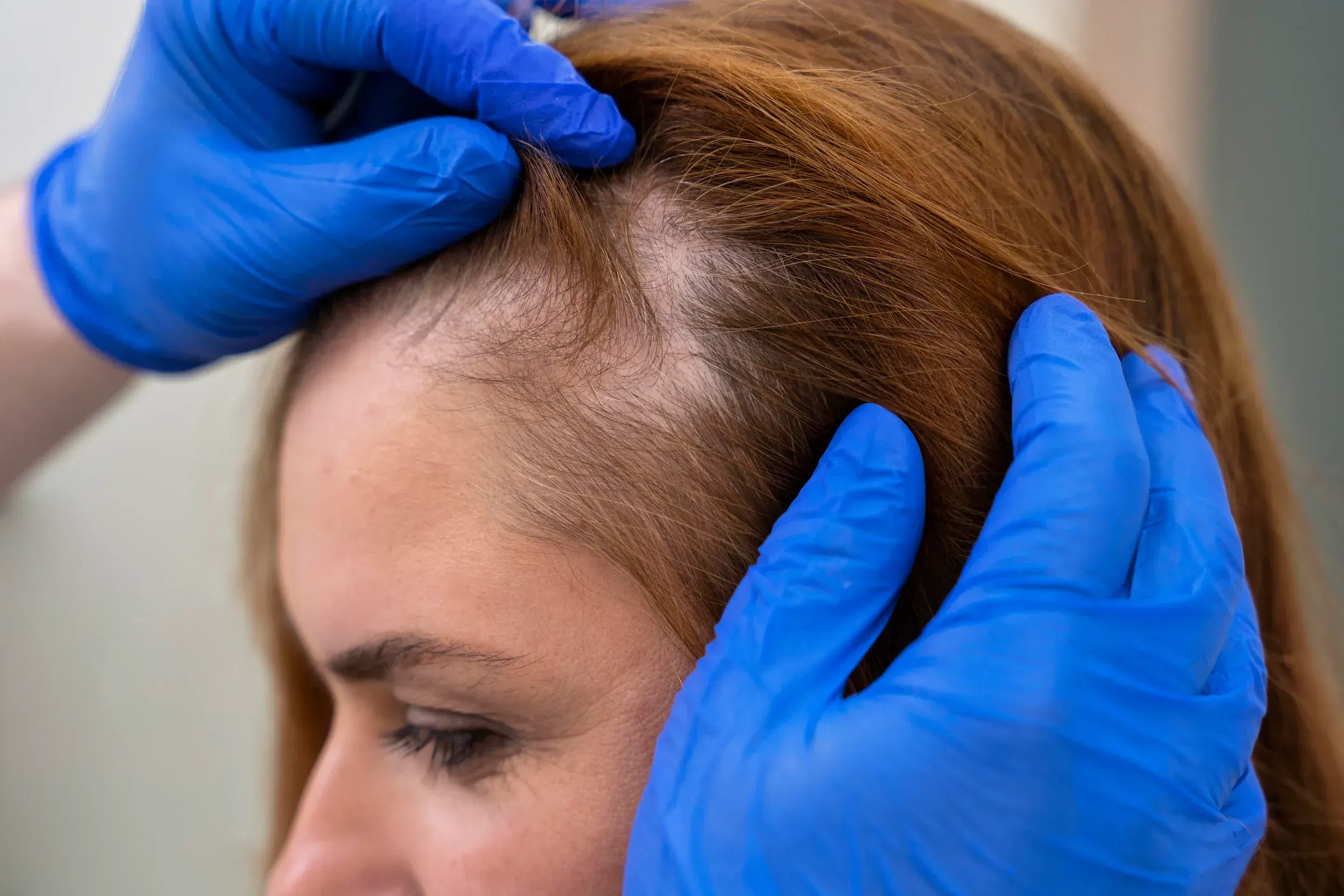 DSI Hair provider in Algonquin Illinois discussing PCOS-related hair loss and androgenic alopecia treatment options with a female patient during a hair restoration consultation